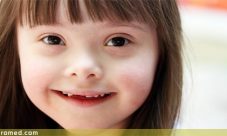 Sindrome de Down (Definición, características, causas y síntomas)