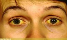 Sindrome de Gilbert