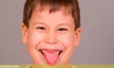 Sindrome de Angelman