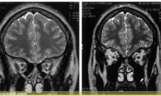Sindrome de Kallman