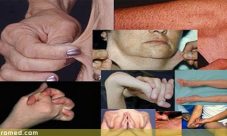 Sindrome de Marfan