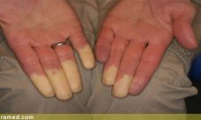 Sindrome de Raynaud
