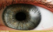 Sindrome de Sjogren