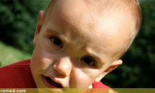 Sindrome de Sotos