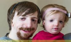Sindrome de Treacher Collins