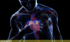 Sindrome Brugada