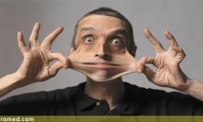 Sindrome de Ehlers-Danlos