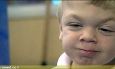 Sindrome de Hurler