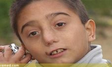 Sindrome de Seckel
