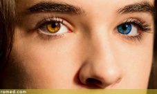 Sindrome de Waardenburg