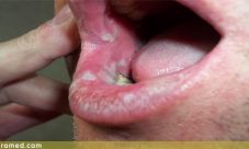 Sindrome de Stevens-Johnson