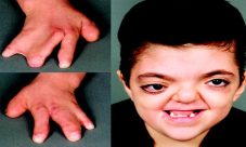 Sindrome Apert