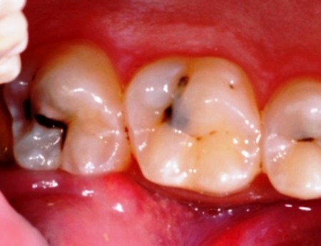Características de las caries dentales