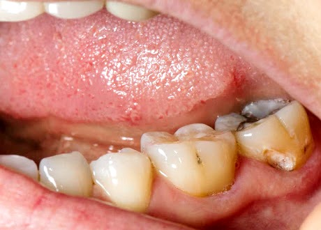 ¿Cómo eliminar las caries?