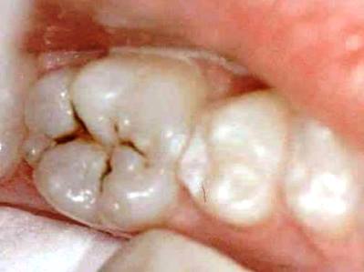 ¿Cómo es una caries dental?
