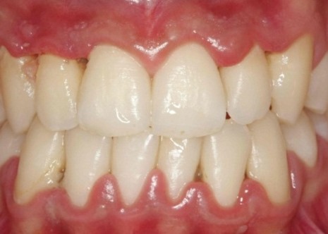 Qué es la gingivitis