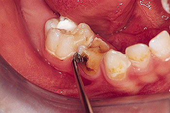Síntomas de las caries dentales