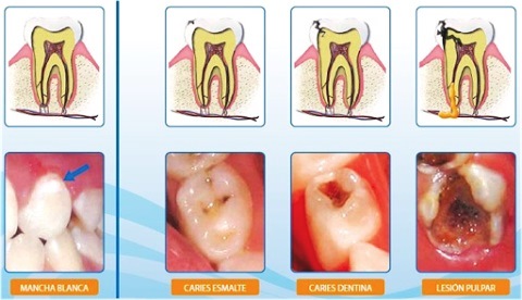 Tipos de caries dental