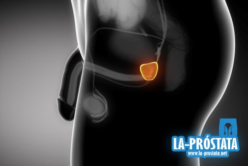 Causas del cáncer de próstata
