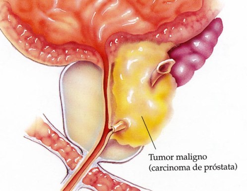 Cáncer de próstata