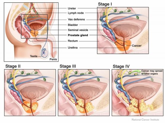 Etapas del cáncer de próstata