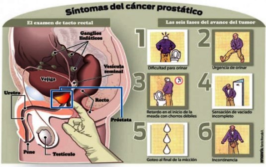 Signos y síntomas del cáncer de próstata