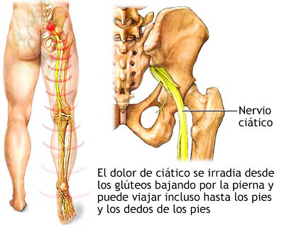 Qué es el nervio ciático