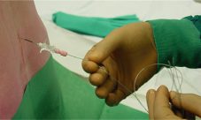 La decisión de la anestesia epidural durante el parto