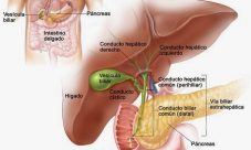 Cáncer de la vesícula