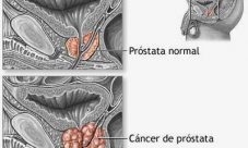Cáncer de próstata