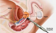 ¿Cómo se detecta el cáncer de próstata?