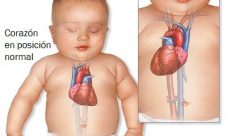 Dextrocardia