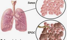 Enfermedad Pulmonar Obstructiva Crónica (EPOC)