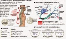 Qué es la esclerosis múltiple