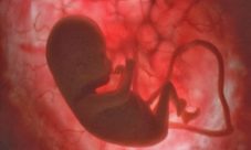 El aborto y su diagnóstico fetal