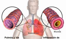 Lo que usted debe saber sobre la Bronquitis