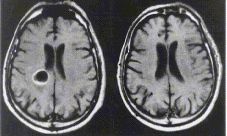 Qué es un tumor cerebral