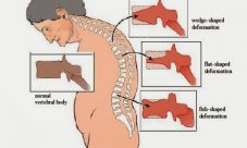 Qué es la Vertebroplastia