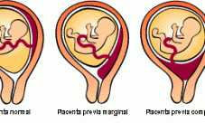 Placenta previa ¿Qué es?