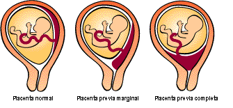 Placenta previa ¿Qué es?