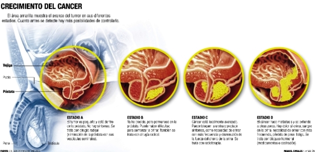 ¿Cómo se produce un cáncer de próstata?