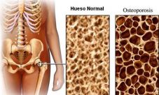 Síntomas del cáncer de huesos