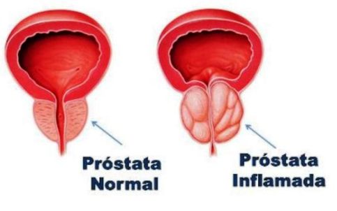 ¿Qué hacer para desinflamar la próstata?