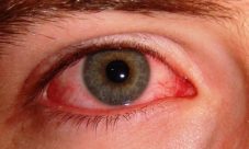 ¿Por qué se ponen los ojos rojos?