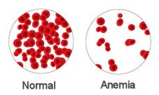 ¿Qué es la anemia y cuáles son sus síntomas?