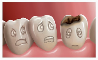 Principales causas de las caries