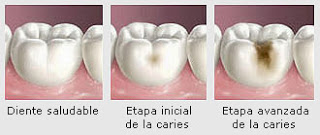 Cómo se desarrolla una caries dental