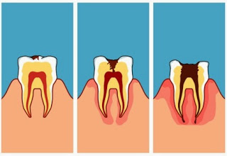 Etapas y tratamiento de una caries dental