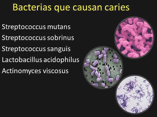 ¿Cuáles son las bacterias que producen la caries dental?