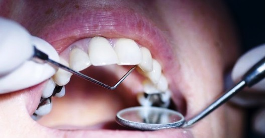 ¿Cómo afecta la caries dental al sistema digestivo?
